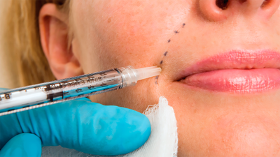 Dermal Fillers in Greater Kailash, Delhi — Subtle Volume, Contour and Refresh