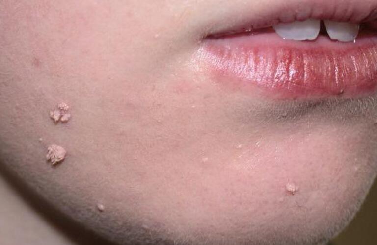 Case 29: Rough, Cauliflower-Like Growths on the Finger — Viral Warts (Verruca Vulgaris / Filiform Wart)