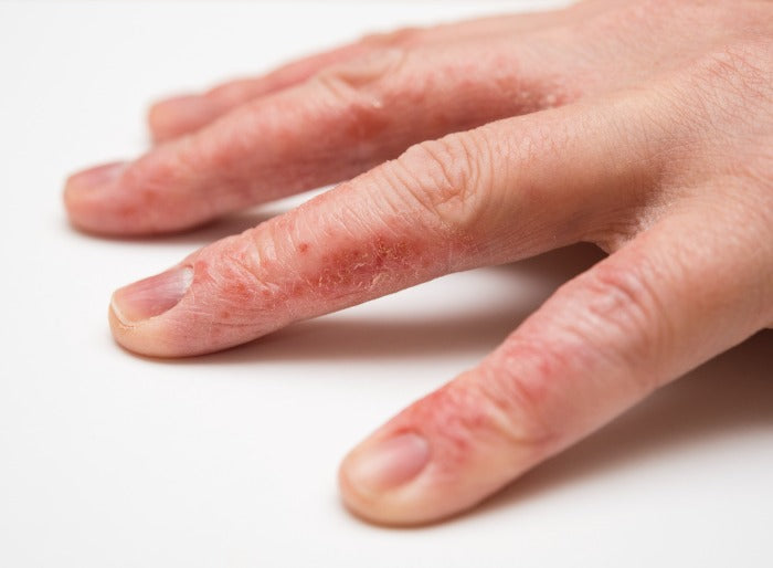 Case 28: A Year of Itchy, Cracking Fingers — Hand Eczema and Allergic Contact Dermatitis