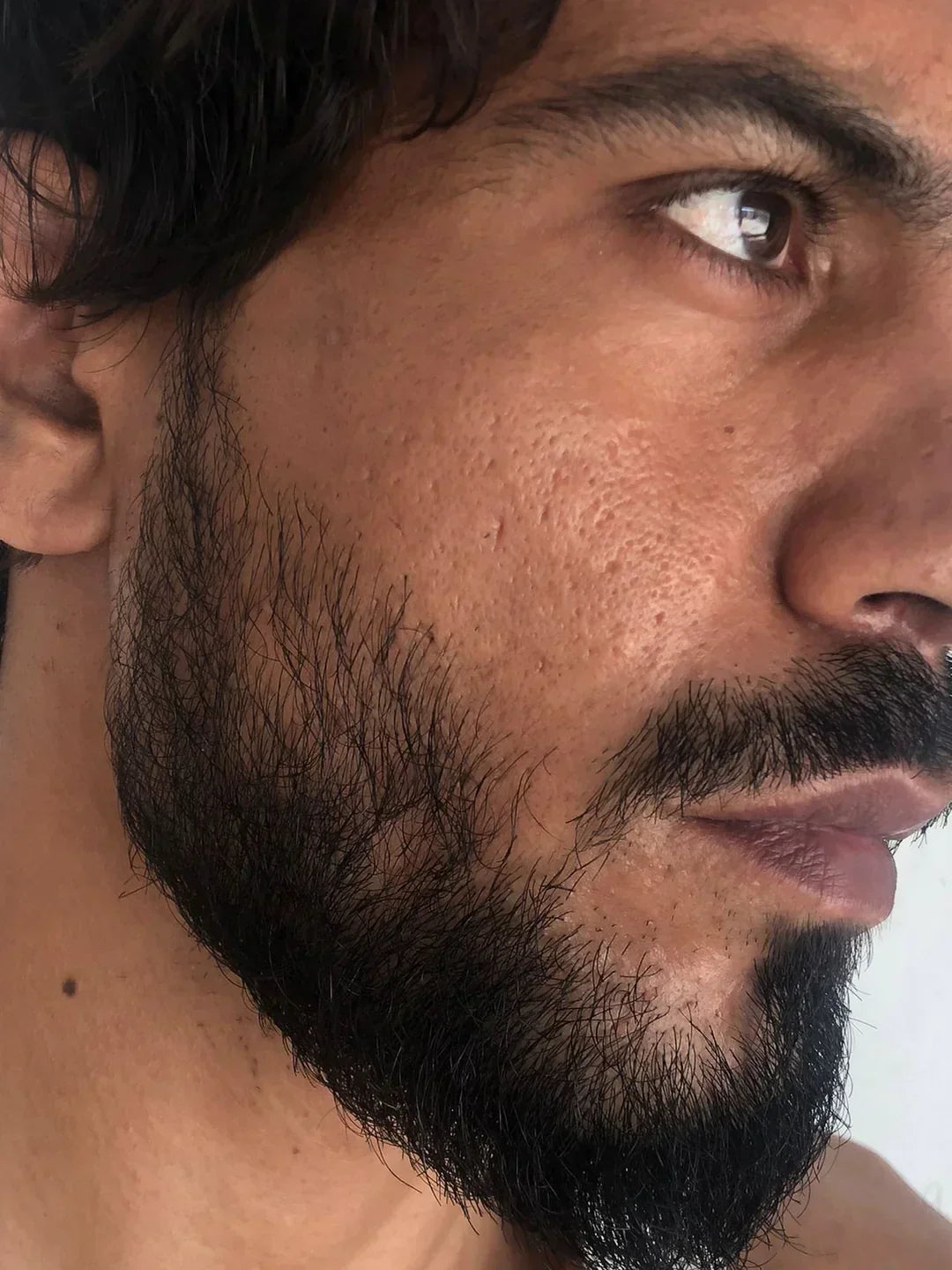 Case 18: Large Open Pores, Acne Scars and Early Forehead Lines Together — Building a First Skincare Routine That Works