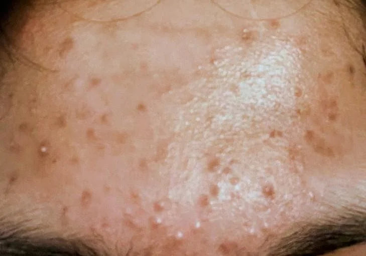 Case 22: Bumps, Pimples and Dark Marks on the Forehead — Comedones with Post-Acne Pigmentation