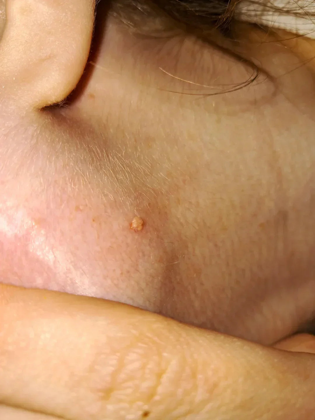Case 33: A Small Bump on the Neck With a White Center — Molluscum Contagiosum Explained