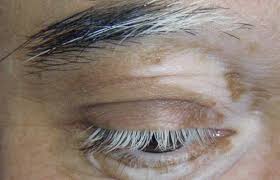 Case 19: White Patches Above the Eyebrows — Pityriasis Alba, and the Light Patches That Must Not Be Missed
