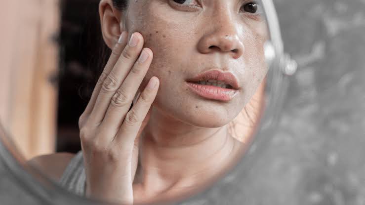Dull Skin Remedies: Brighten for a Healthy Glow