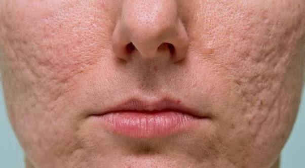 Acne Scar Therapies: Options for Clearer, Smoother Skin