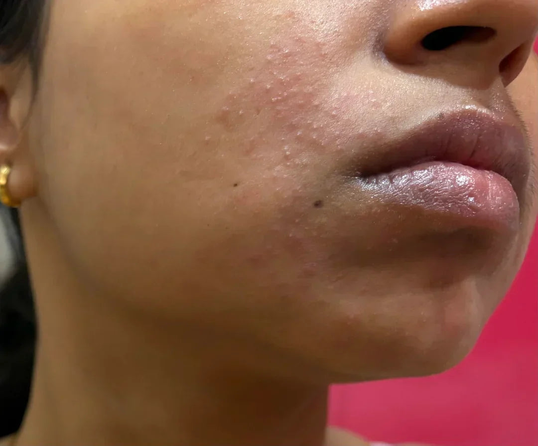 Case 16: Red Bumps and Pus Points After New Skincare — Cosmetic Acne and Overuse of Actives