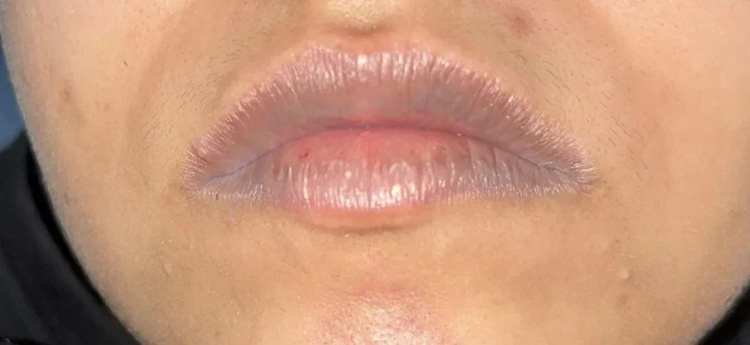 Case 21: Burning, Cracking Corners of the Lips — Angular Cheilitis and Lip Irritation Explained