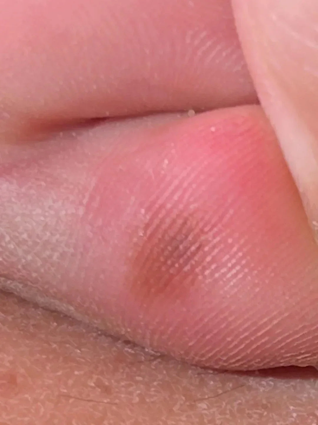 Case 34: Small Black Spots on the Sole or Finger Pulp — Talon Noir (Black Heel), the Athlete's Harmless Mimic