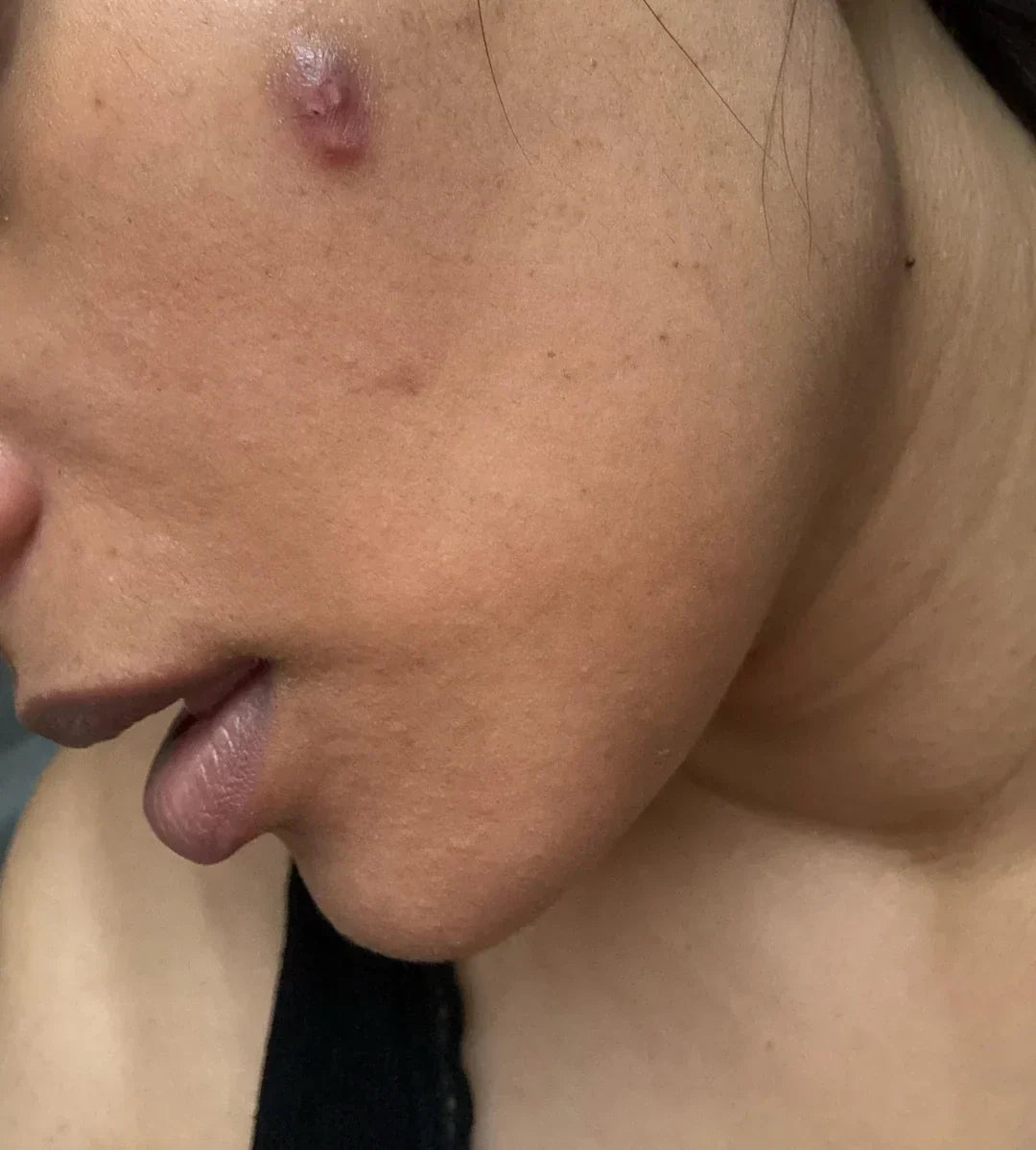 Case 23: A Pimple That's Not Painful but Won't Go Away — The Inflamed Nodule That Overstays