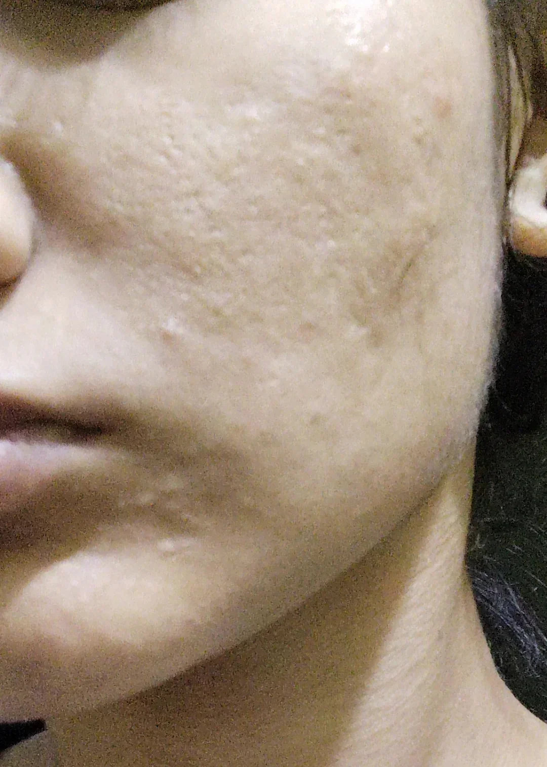 Case 17: Depressed Areas and Uneven Texture at Under 20 — Acne Scarring in Young Skin, and Why Early Treatment Matters
