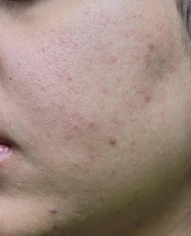 Case 13: "Retinol Is Making My Skin Worse" — Retinoid Dermatitis and the First-Month Purge Explained