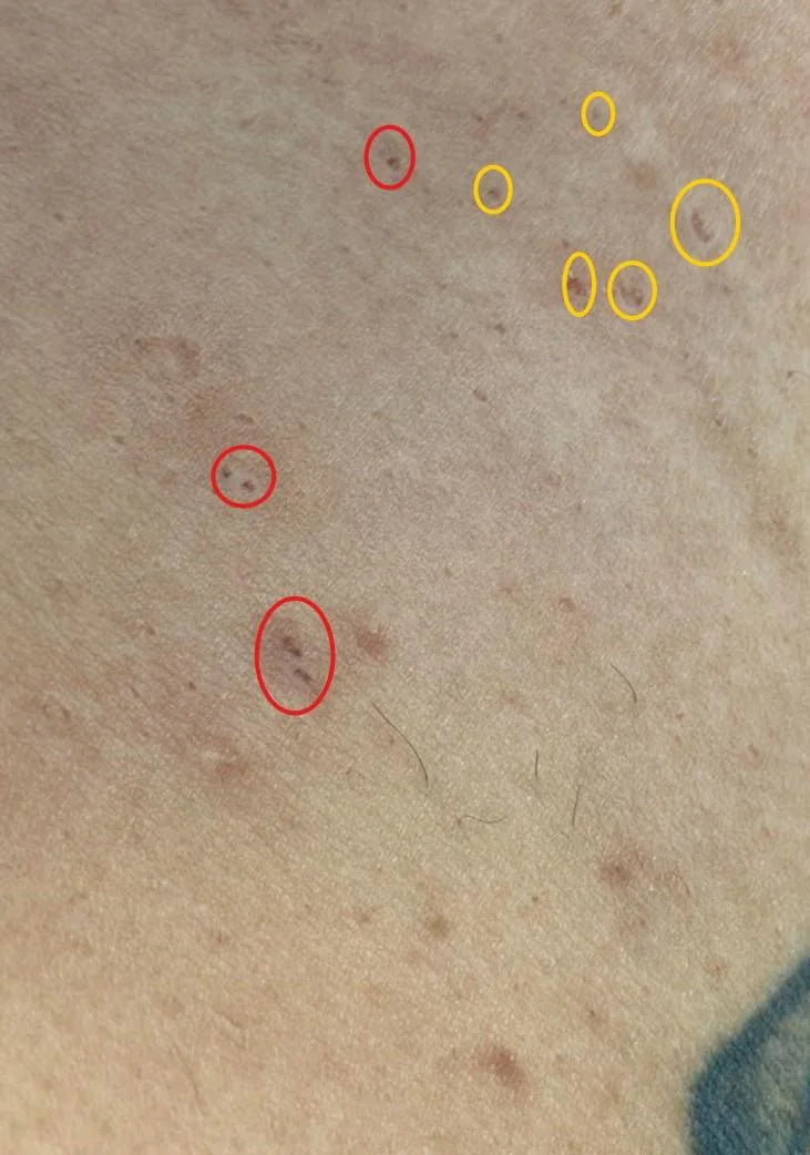 Case 36: 'Tiny Holes' Appearing in the Skin — Anetoderma and Focal Loss of Elastic Tissue