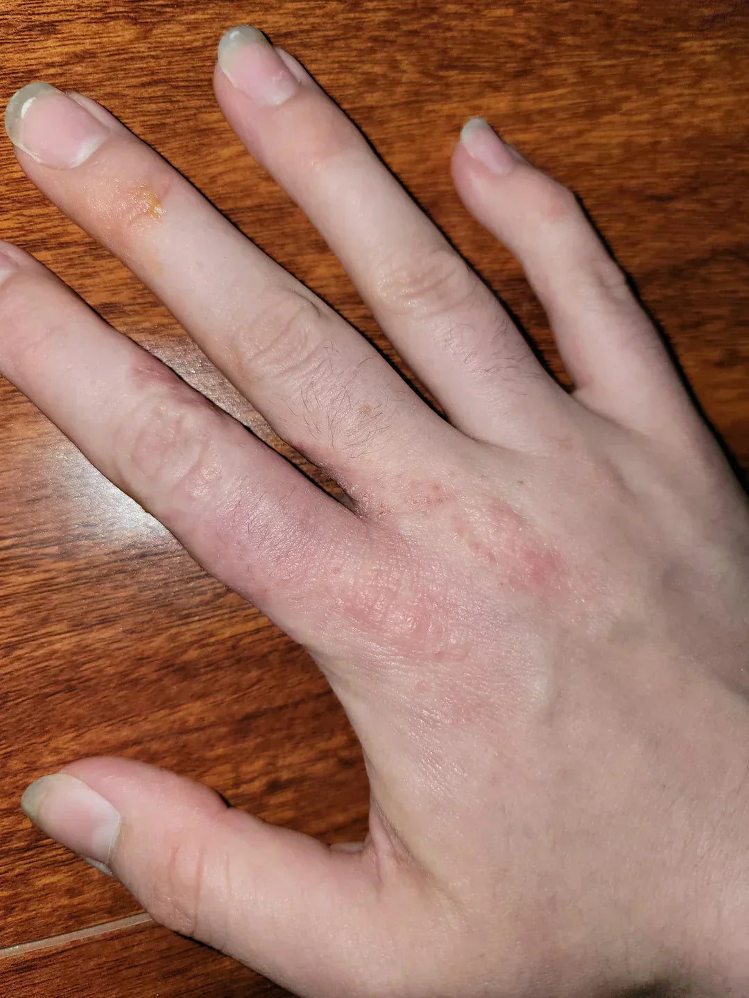 Case 20: Itchy Deep-Seated Blisters on the Fingers and Palms — Dyshidrotic Eczema, and Why Steroid Creams Sometimes Burn