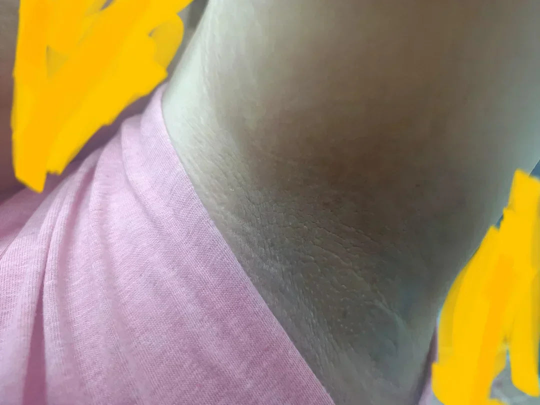 Case 24: Dark, Velvety Skin on the Neck and Underarms — Acanthosis Nigricans, the Skin's Metabolic Warning Light