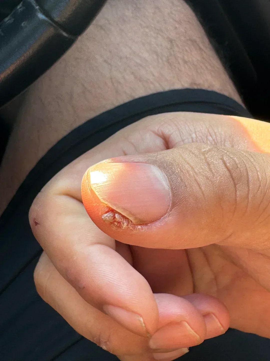 Case 31: A Rough Growth Around the Nail That Won't Heal — Periungual Warts and the Nail-Biting Connection