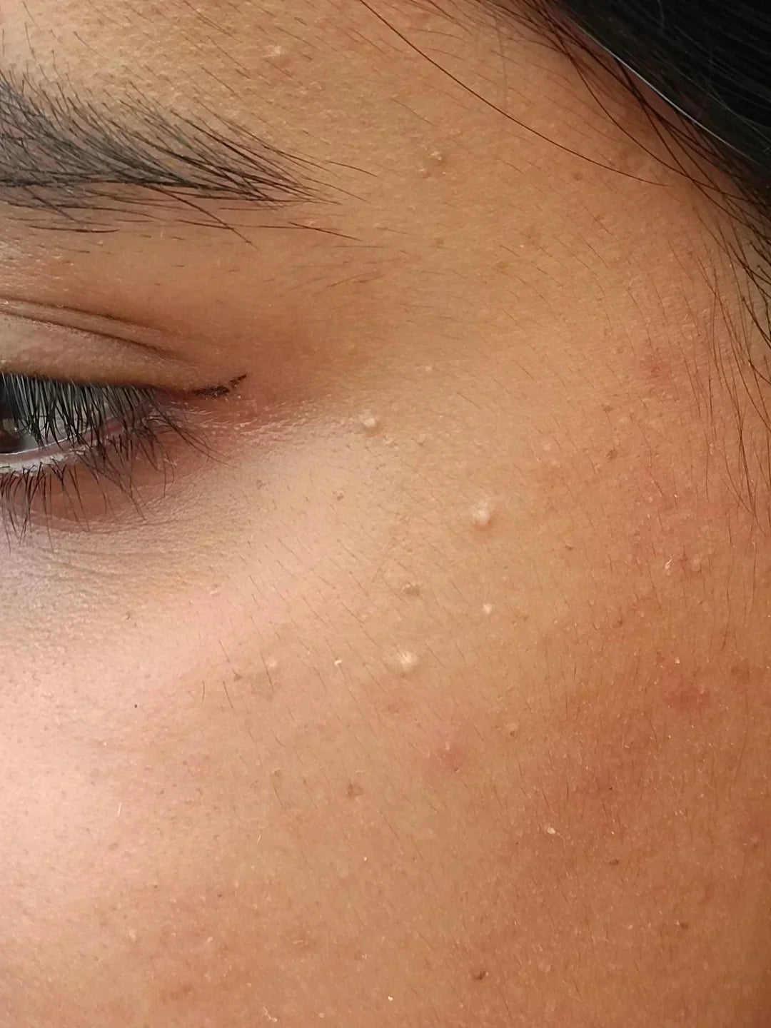 Case 25: Tiny White Bumps That Look Like Whiteheads but Never Pop — Milia Explained