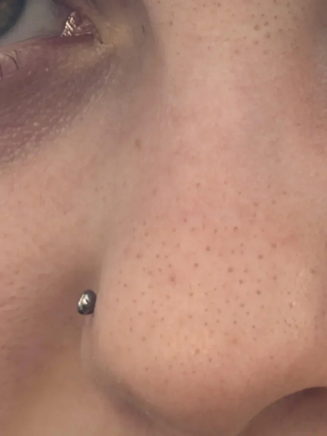 Case 30: Tiny Dark Dots on the Nose That Never Cleanse Away — Trichostasis Spinulosa, the Blackhead Impostor