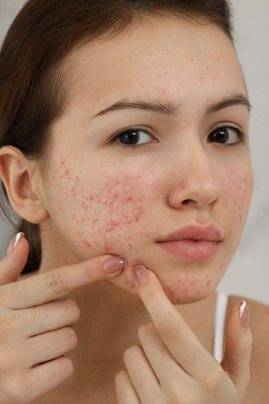 What is Pimple ACNE Scar — dermatologist explanation at Allodermis