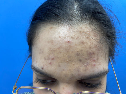Before: Forehead Acne
