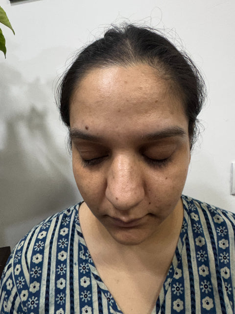 After: Forehead Acne