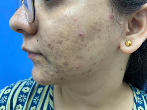 Before: Cheeks Acne
