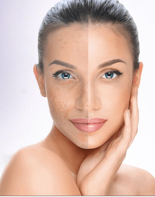 Skin Lightening Treatment treatment at Allodermis — AIIMS MD dermatologist clinic in India