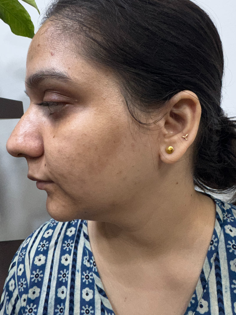 After ACNE Cheeks Treatment