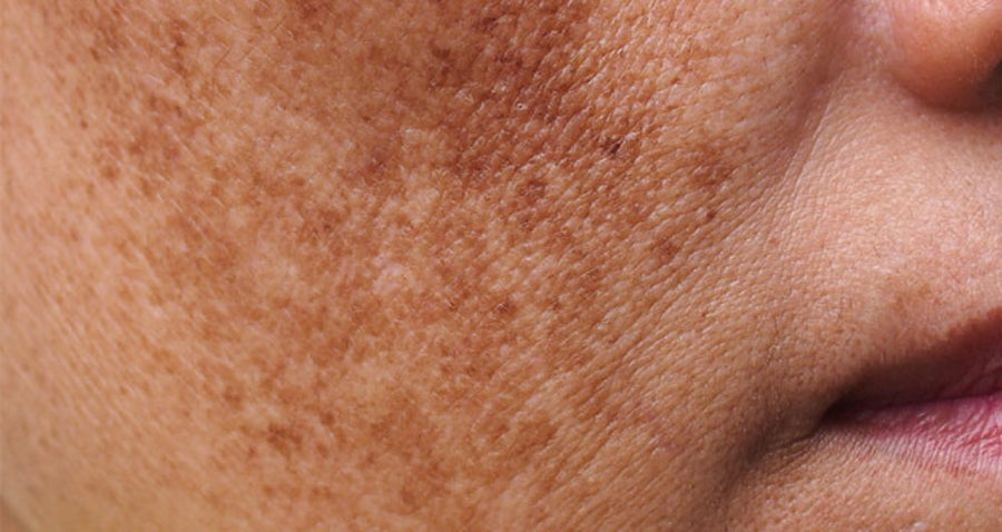 What is Skin Pigmentation — dermatologist explanation at Allodermis