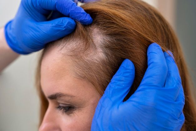 What is Allopecia(Hair Loss) — dermatologist explanation at Allodermis