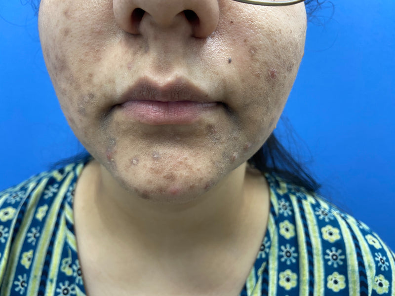 Before SCAR Mark Removal