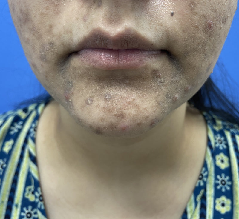 Before ACNE Chin & Jawline Treatment