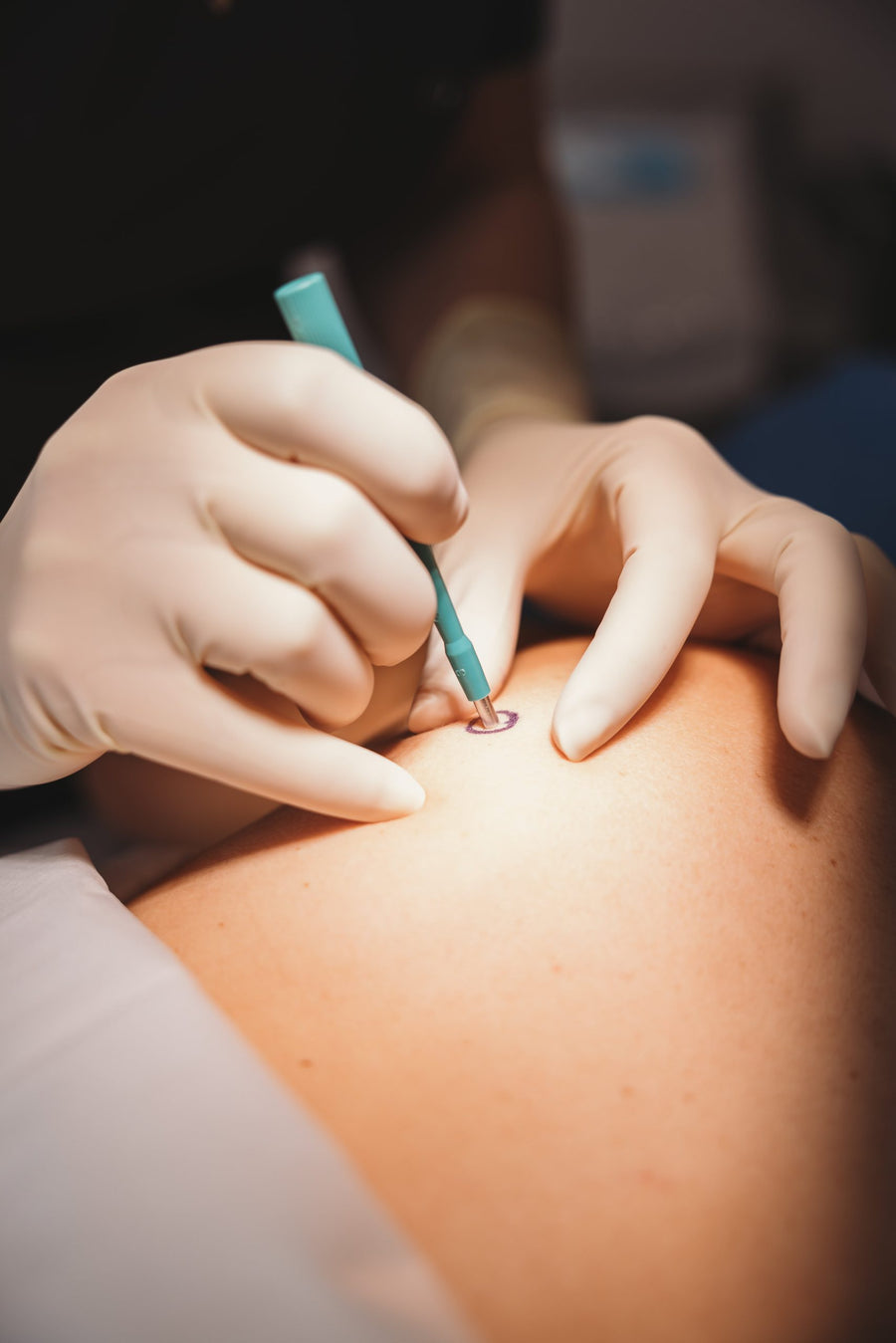Skin Biopsy Procedure treatment at Allodermis — AIIMS MD dermatologist clinic in India