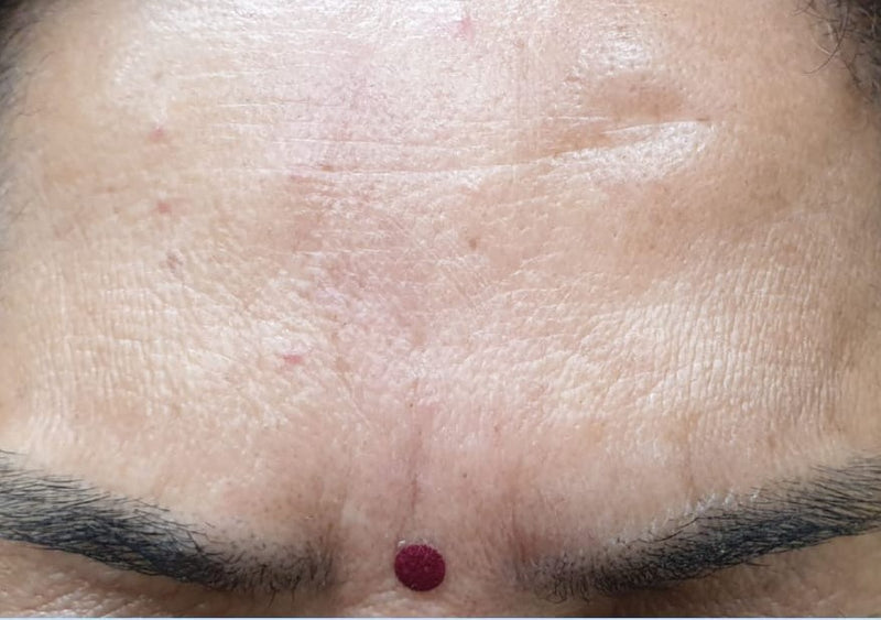 After Botox on Forehead