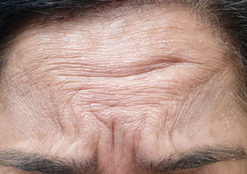Before Botox on Forehead