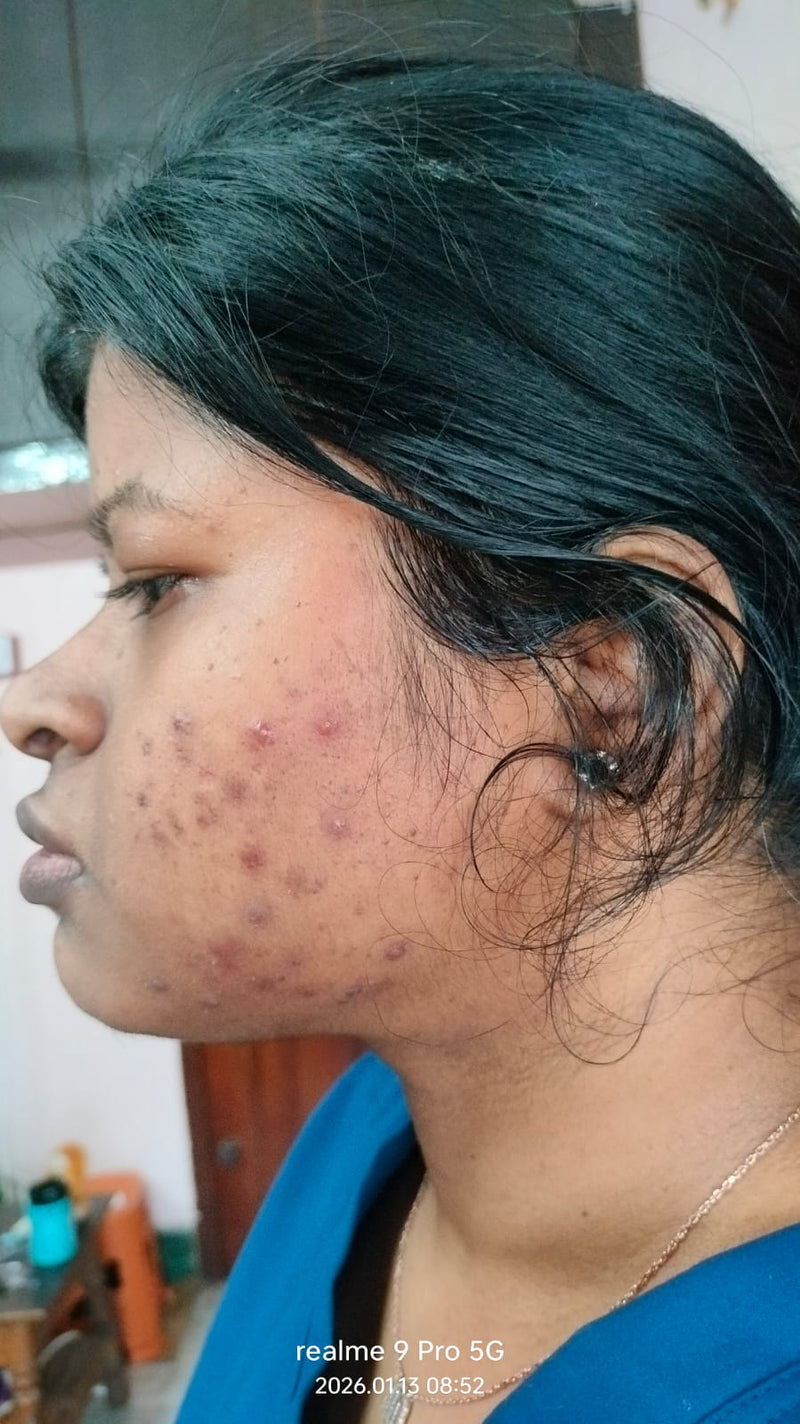 Before SCAR Mark Removal