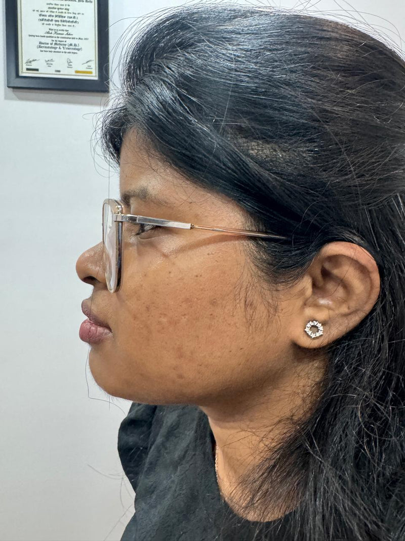 After SCAR Mark Removal