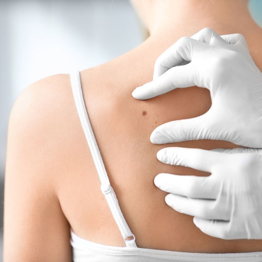 Birthmarks and Moles treatment at Allodermis — AIIMS MD dermatologist clinic in India