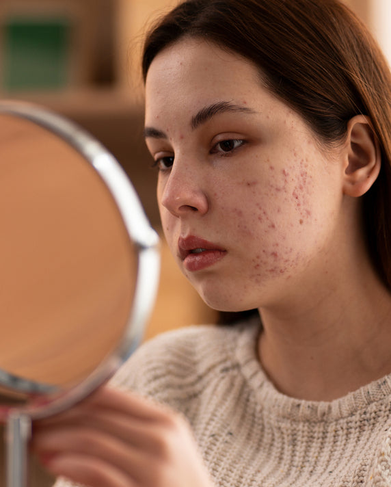Acne & Pimple Treatment at Allodermis