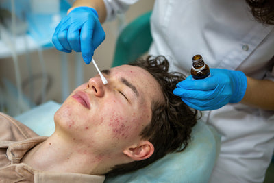 Acne–Scar Treatment