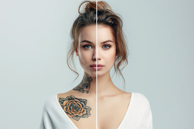 Tattoo Removal