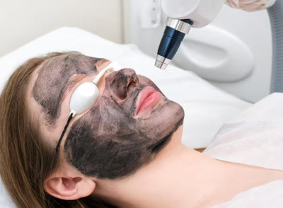 Carbon Laser Peel