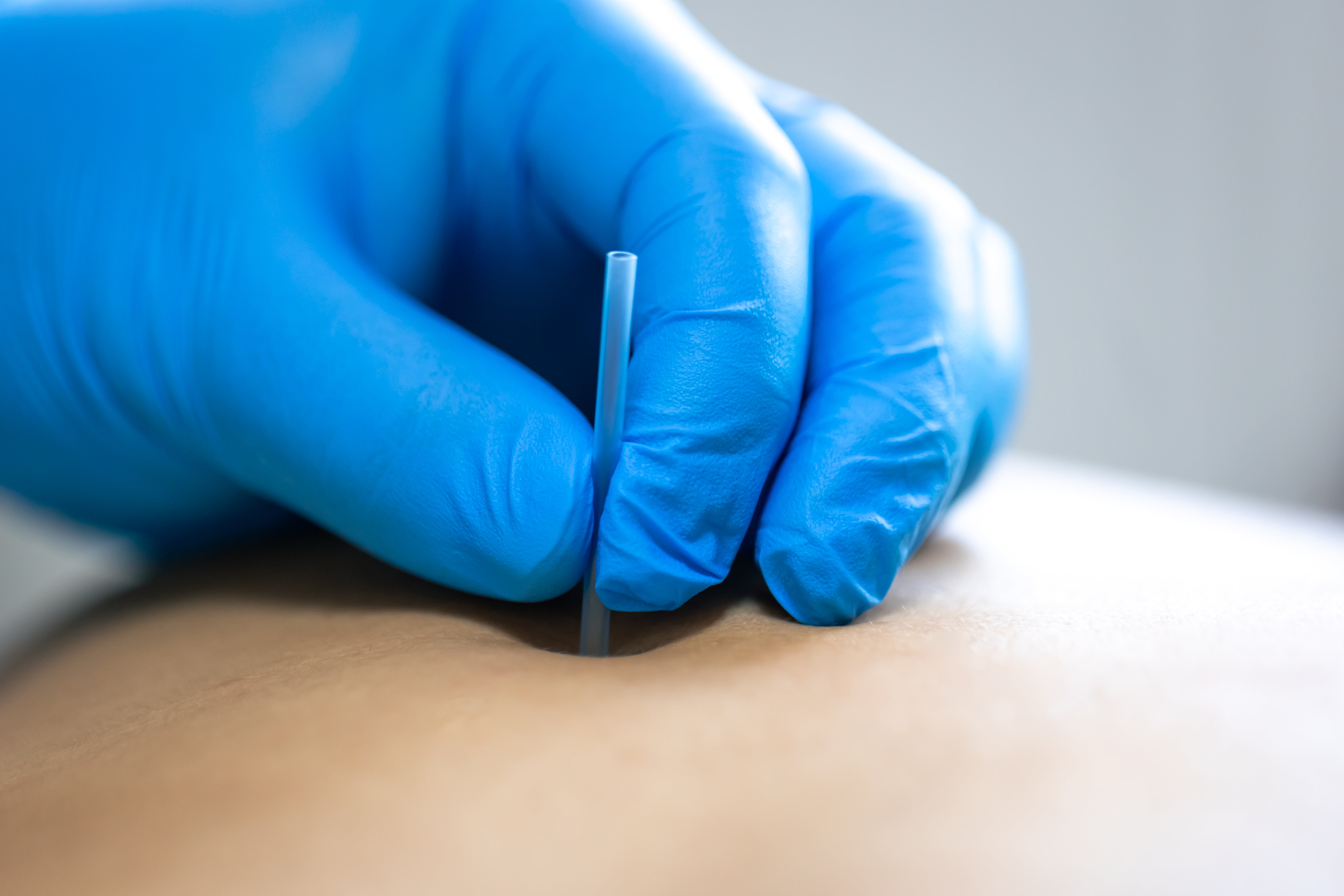 Wart Removal