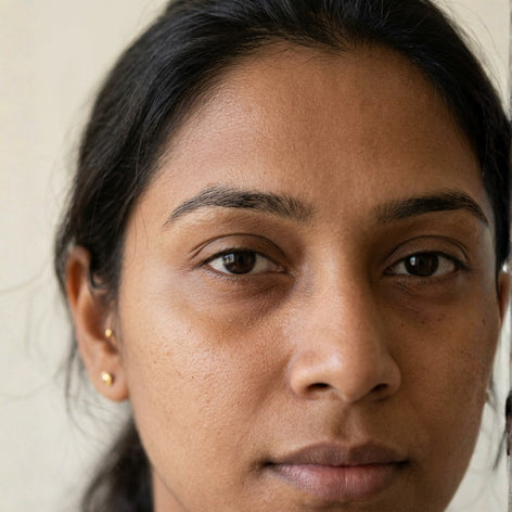 Dark Circles Under the Eyes