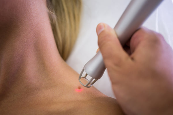 Wart Removal Treatment