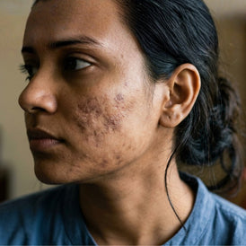 Post-Inflammatory Hyperpigmentation (PIH)