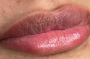 After: Pale or Uneven Lips
