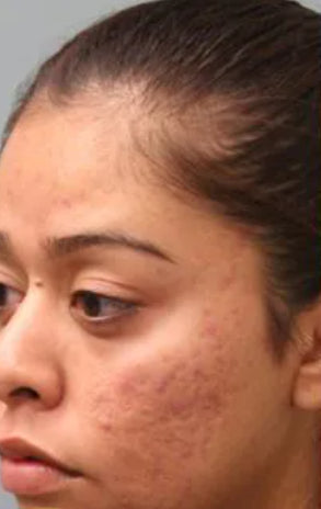 Before Laser SCAR Removal