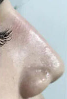 After: Nose Shape Concerns