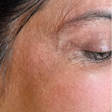 After: Skin Texture & Tone