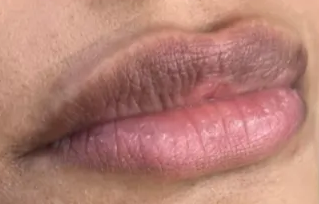 Before: Pale or Uneven Lips